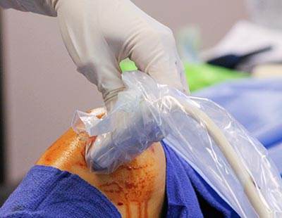 lipogems