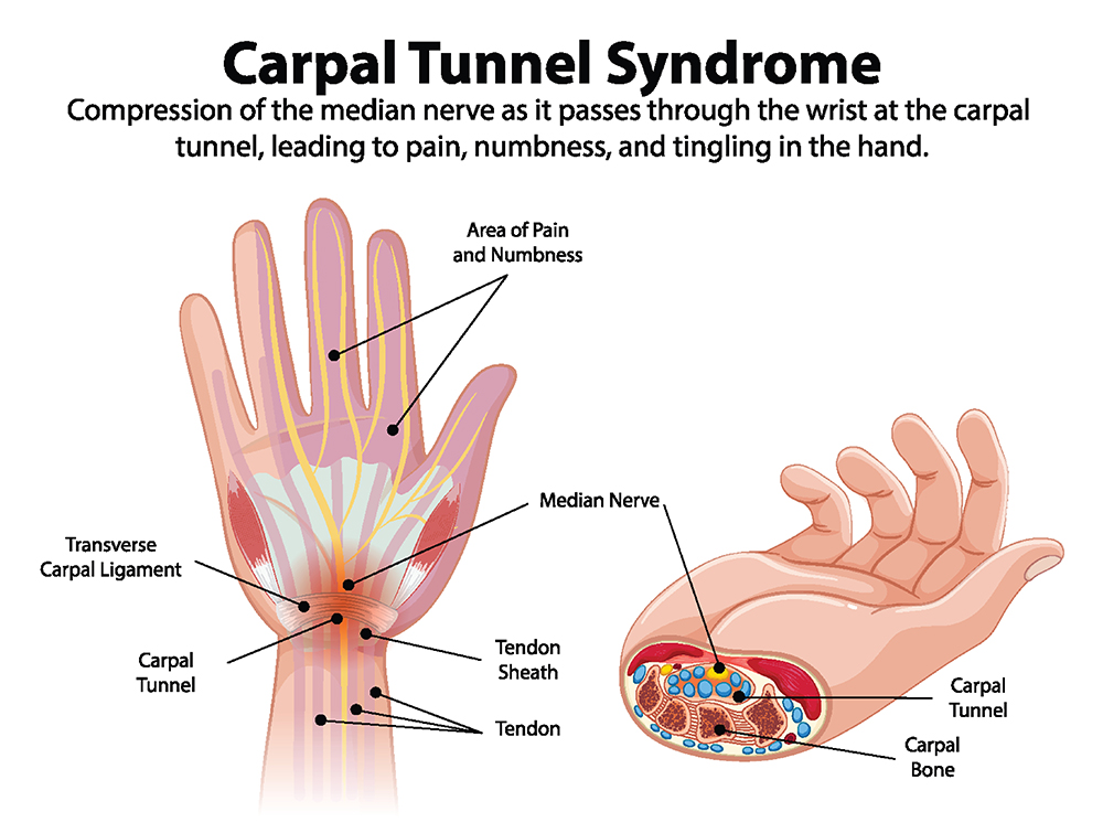 Carpal Tunnel Syndrome