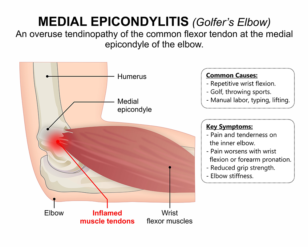 Medial Epicondylitis Golfers Elbow