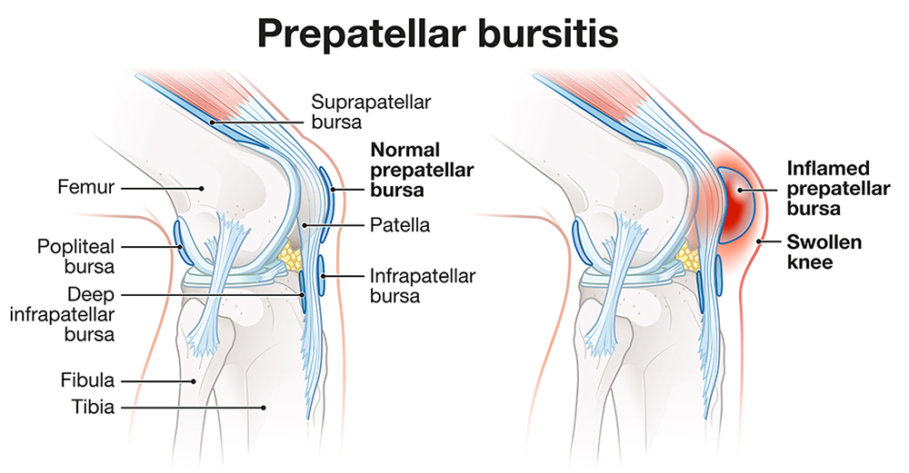 Prepatellar Bursitis