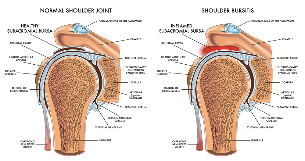 Shoulder Bursitis