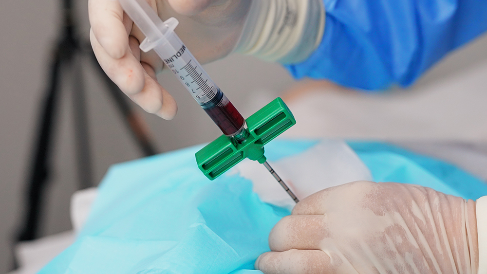Bone Marrow Stemcell therapy