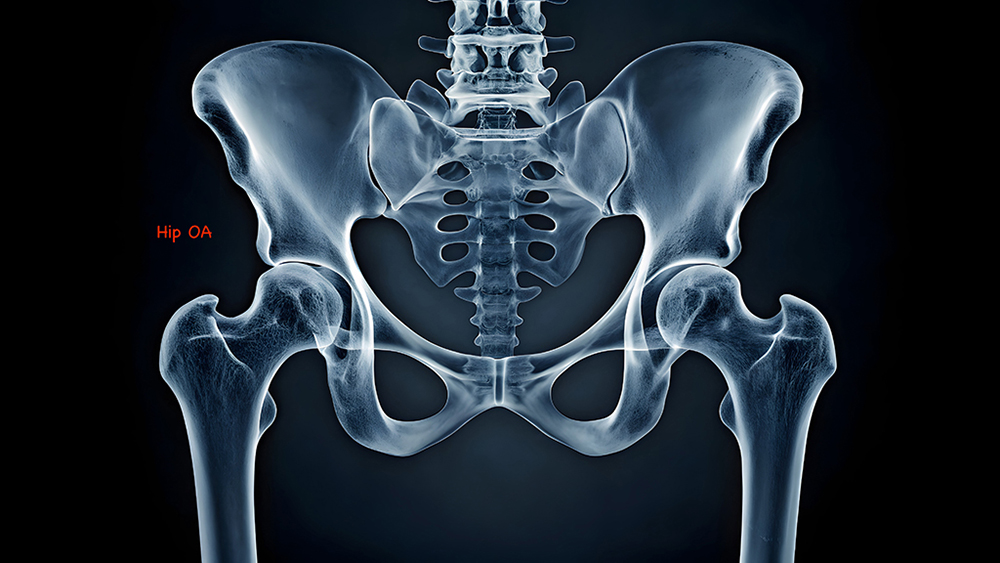 Hip OA X-Ray