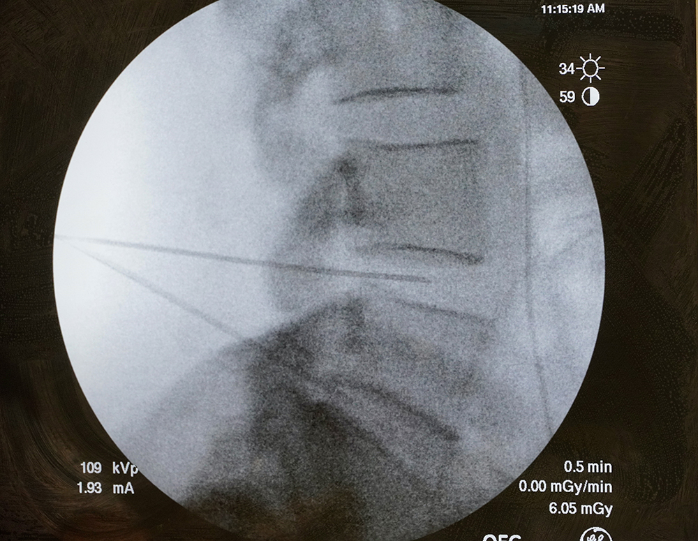 Intradiscal Procedures GE OEC 9900 Elite imaging