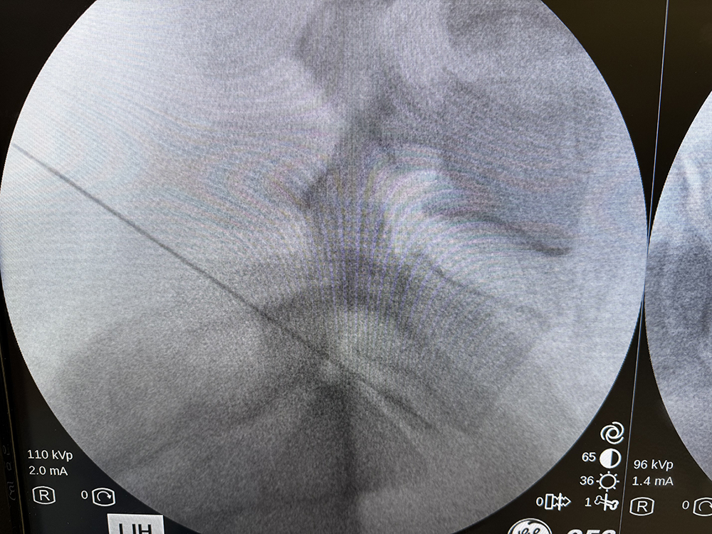 Intradiscal Procedures GE OEC 9900 Elite imaging