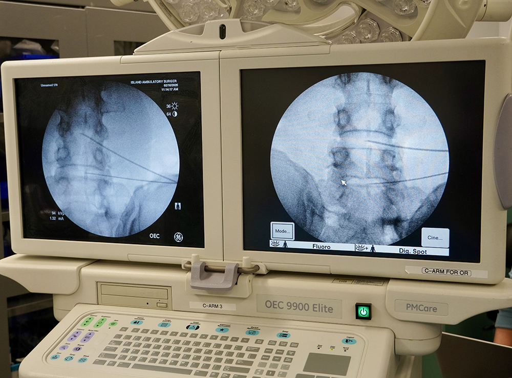 Intradiscal Procedures GE OEC 9900 Elite