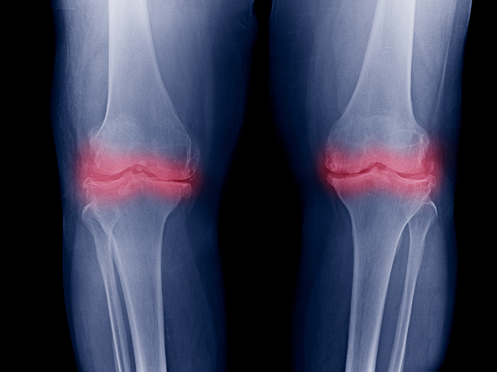 Knee Arthritis XRAY both knees