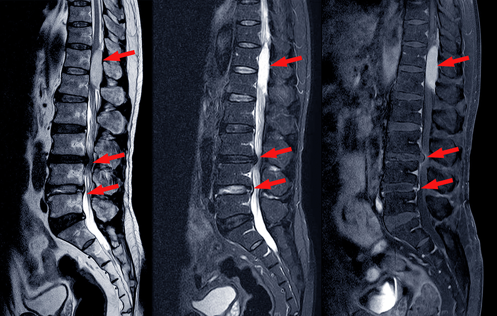 MRI Degenerative Disc