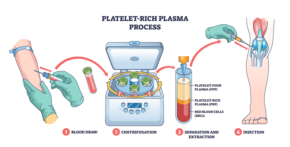 PRP Process Animation