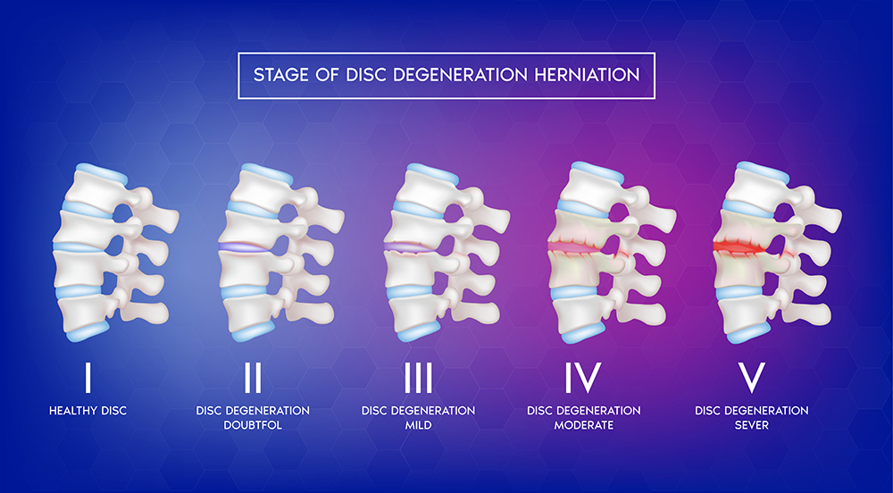 Stages of Degenertive Disc Disease