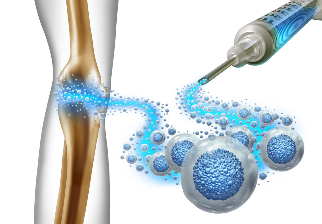 Stem Cell Therapy for Knee Pain
