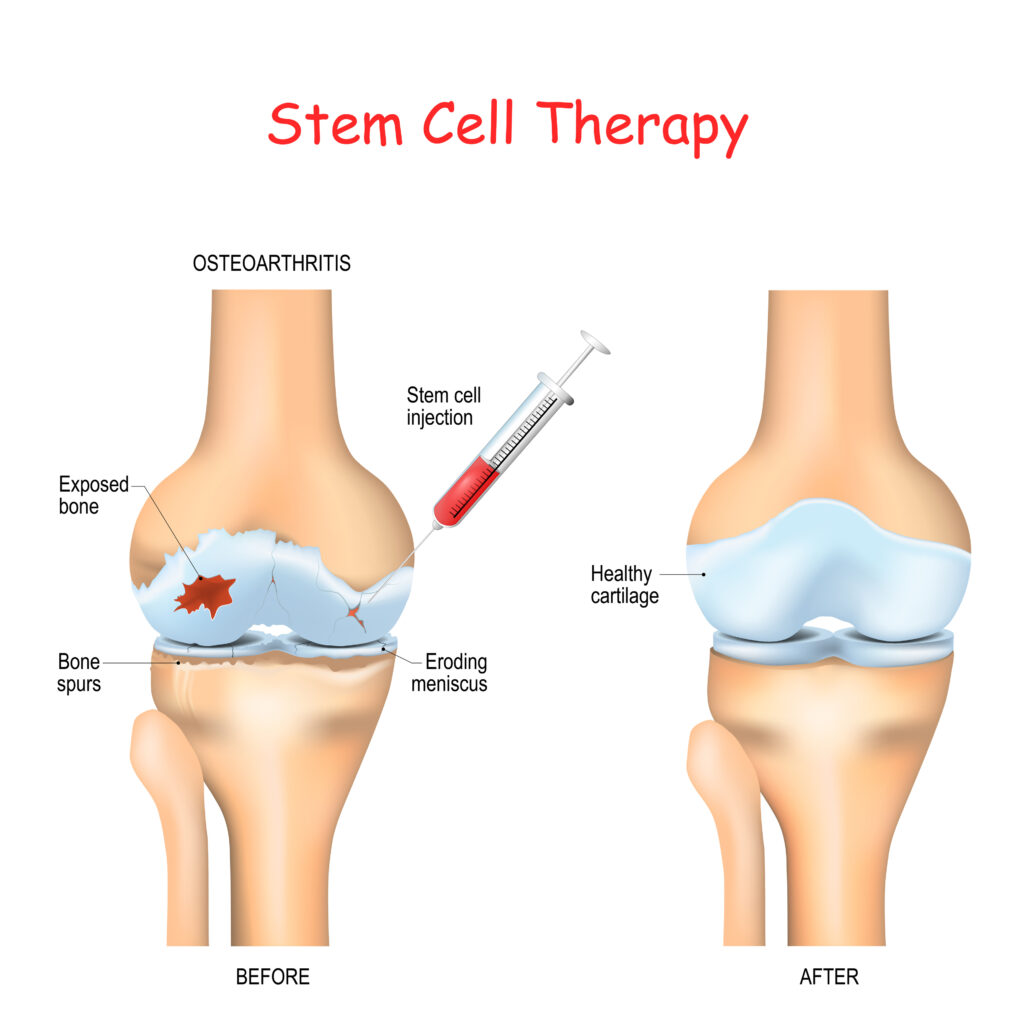 Stem Cell Therapy for Knee OA